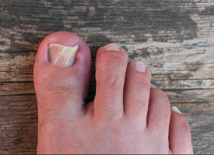 Tratamento de unha encravada